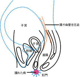 妊娠中 産後の痔 痔 便秘 ママの病気 健康 の教えて ドクター