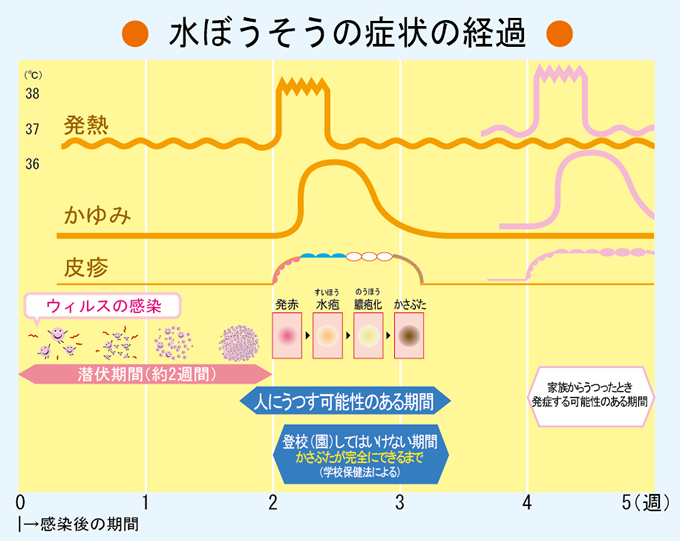 力 水疱瘡 感染