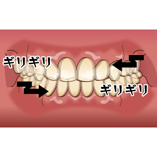 bruxism001.png