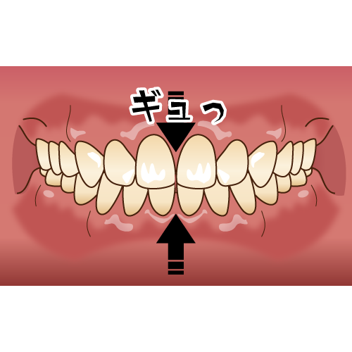 画像に alt 属性が指定されていません。ファイル名: bruxism003.png